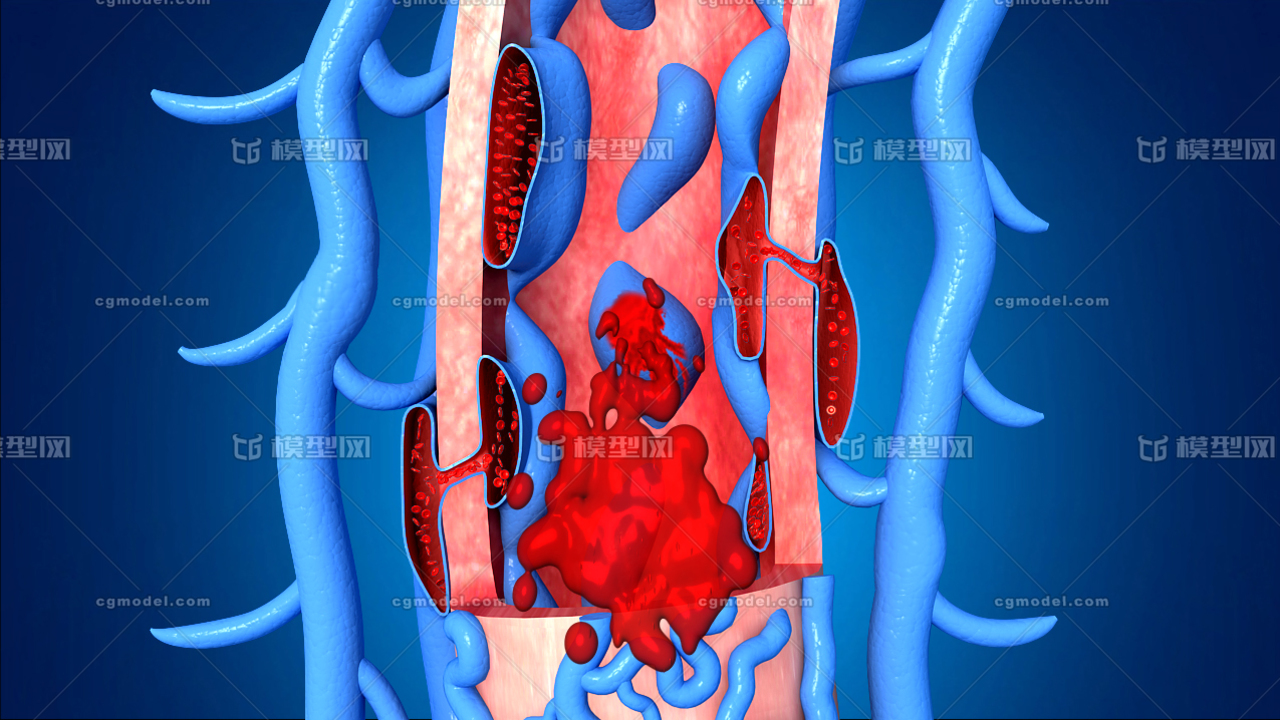 医学动画 胃出血血管破裂,胃部血管,胃出血,人体循环系统 人体结构