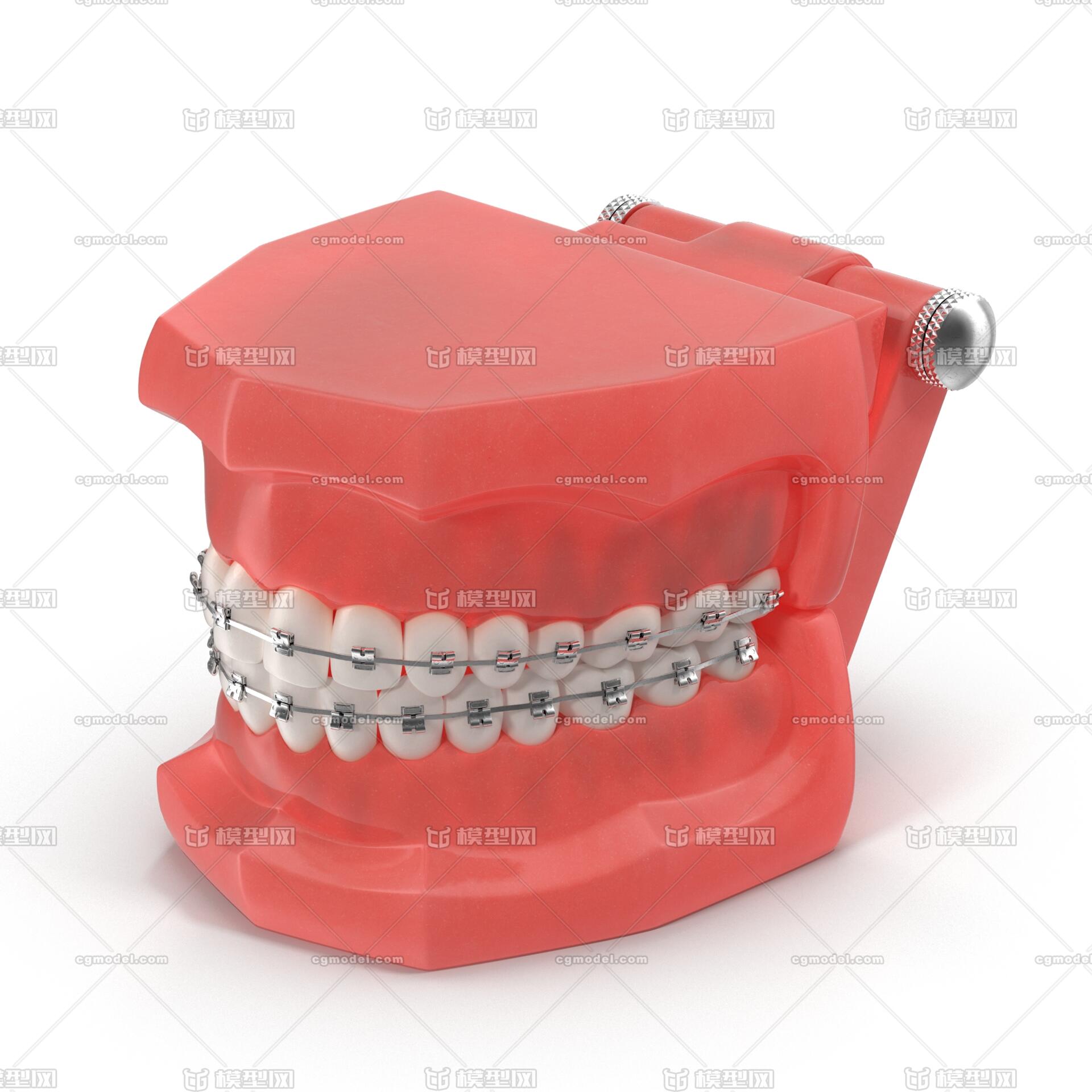口腔牙齿义齿种植牙精细模型