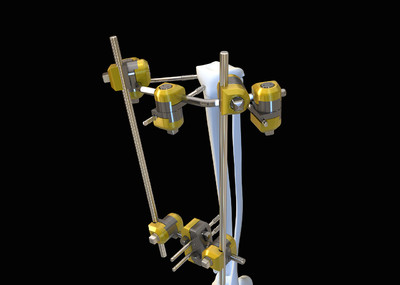 医疗器械 胫骨外固定支架 手术工具 内_医学康复训练作品_机械/器械