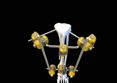 医疗器械  胫骨外固定支架 手术工具 内科 外科  损伤 创伤恢复  医学