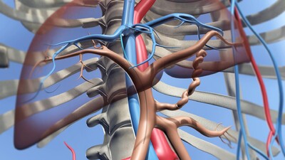 经颈静脉肝内门体静脉分流,静脉穿刺tipss
