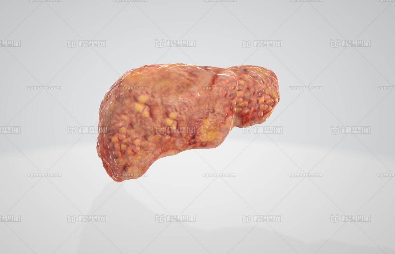 脂肪肝解剖图片图片