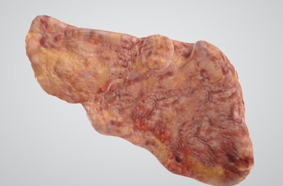 脂肪肝解剖图片图片