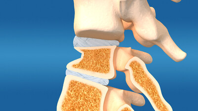 医学动画 人体骨骼 脊柱骨折 骨小梁 骨质疏松 骨密度 骨损伤 椎间盘